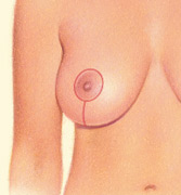 Lollipop breast lift scarring