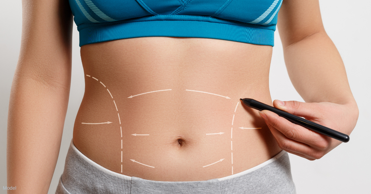 Woman considering liposuction in Richmond, VA.