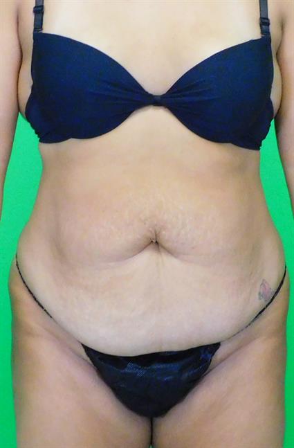 Before tummy tuck photo of a female patient