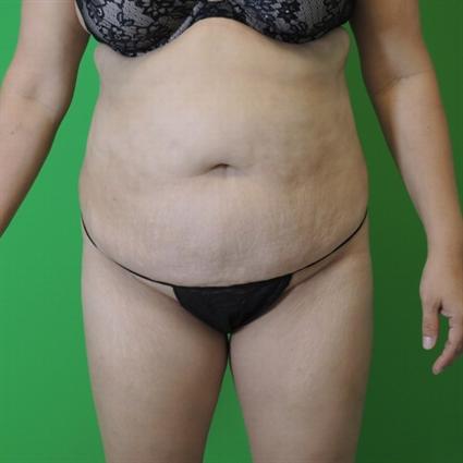 Photo of a female patient before tummy tuck surgery