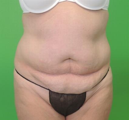 Photo of a female patient before her tummy tuck surgery